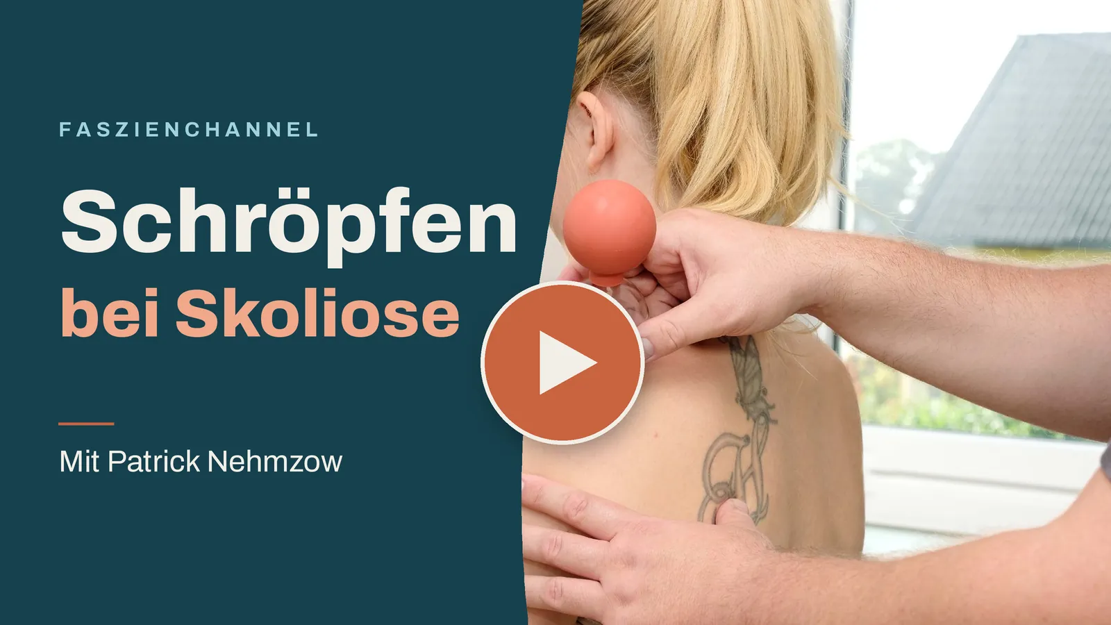 Vorschaubild zum Faszienchannel-Video „Schröpfen bei Skoliose“ mit Patrick Nehmzow